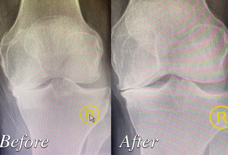 Photo of Before and after treatment by Granite Bay Medical Center